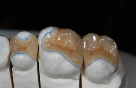 Ceramic Inlays And Onlays Ralev Dental Clinic