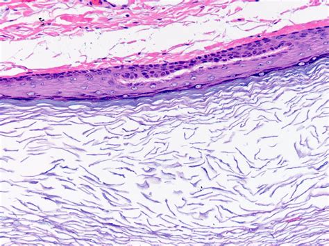 Epidermal Inclusion Cysts Eic Epidermoid Cysts