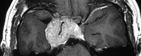 Parasellar Meningioma Radiopaedia