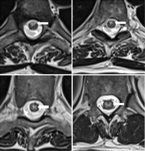 Frontiers Case Report Dueling Etiologies Longitudinally Extensive