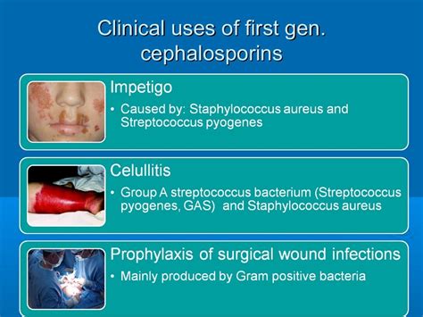 Cephalosporins Historyclassificationsarsynthesismechanism Of Act