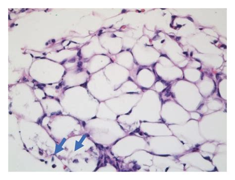 Hematoxylin Eosin Stained Section Of The Skin Biopsy Shows In A