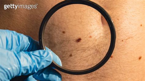 Mole Dermoscopy Preventive Of Melanoma Dermatologist Examining