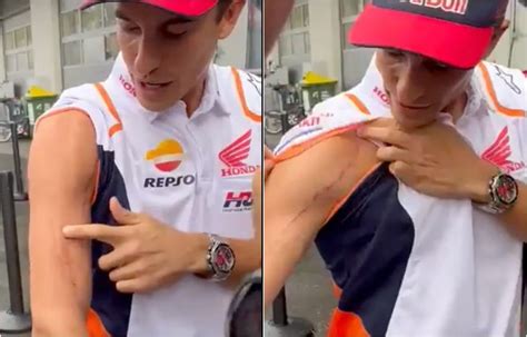 Marc Marquez Mostra Le Cicatrici Al Braccio Destro Martoriato Dalle