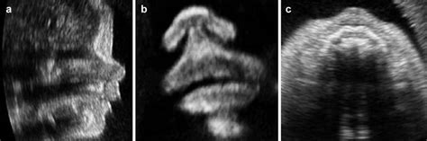 Cleft Lip 3d Ultrasound