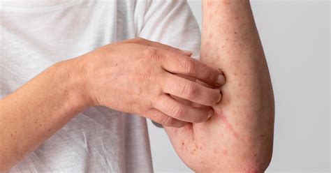 Rimedi Naturali Per La Psoriasi Neobilive