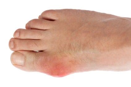 Gout Symptoms - Experiments on Battling Gout