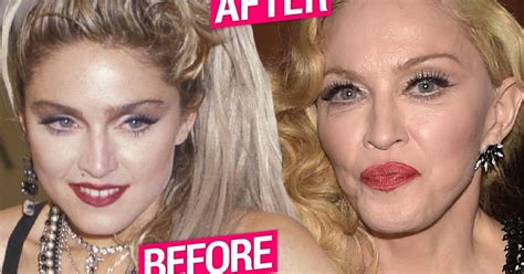 Madonna Plastic Surgery Secrets Revealed