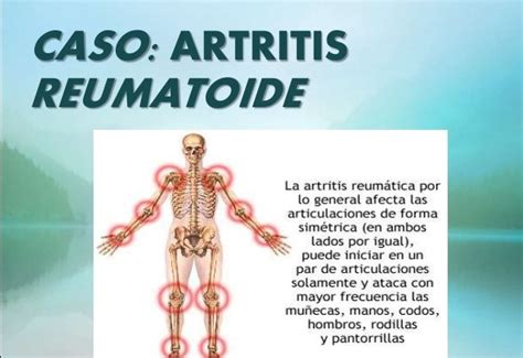 Artritis Reumatoide S Ntomas Prevenci N Y Tratamiento