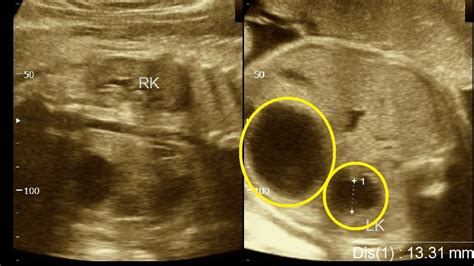 34 Weeks Pregnancy Fetal Hydronephrosis Amader Hospital Ultrasonography Report Part 1