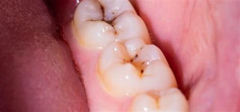 ¿qué Es Un Empaste Dental Y Cómo Se Hace Ferrusandbratos