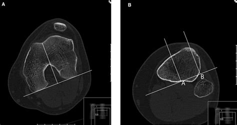 Lateral Patellar Compression Syndrome Knee And Sports Orthobullets