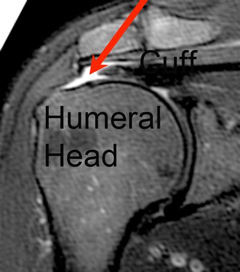 Shoulder Arthritis / Rotator Cuff Tears: causes of shoulder pain: Rotator Cuff 8 - anatomy, MRI ...