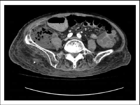 Figure 2 From A Rare And Fatal Cause Of Right Iliac Fossa Pain—when Retroperitoneal Necrotizing