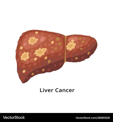 Liver Cancer Icon Isolated On White Background Vector Image