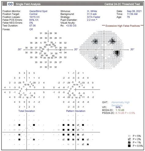 Seguimiento De La Progresión Del Glaucoma Lo Aprobado Lo Verdadero Y