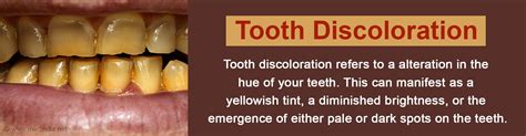 Tooth Discoloration Causes Symptoms Treatment Prevention