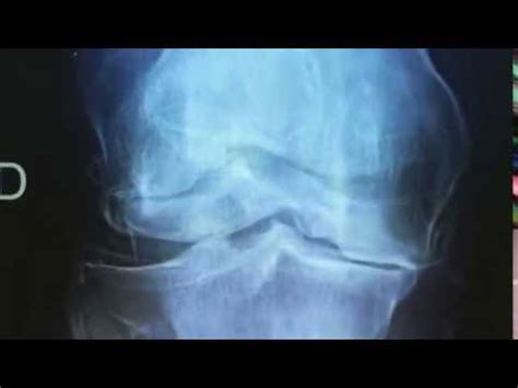 Plasma Rico En Plaquetas En Artrosis De Rodilla Youtube