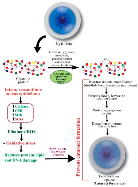 Cataracts Encyclopedia Mdpi