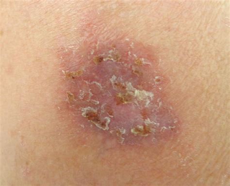 Squamous Cell Carcinoma Arising In Smallpox Vaccination Scar The Bmj