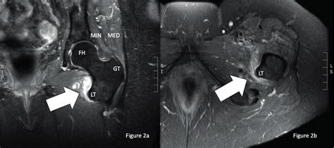 Complete Tear Of The Left Iliopsoas Tendon A Coronal T2