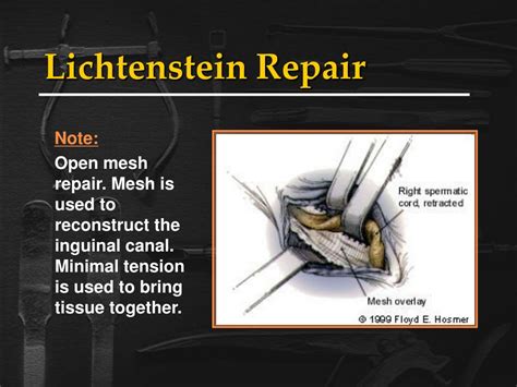 Ppt Inguinal Hernias Powerpoint Presentation Free Download Id 218475