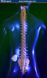 Spinal Pain Pump | SINW Implanted Pain Relief System