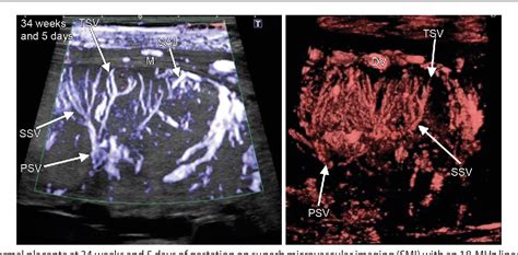 Superb Microvascular Imaging Assessment Of Placenta Using An 18 MHz