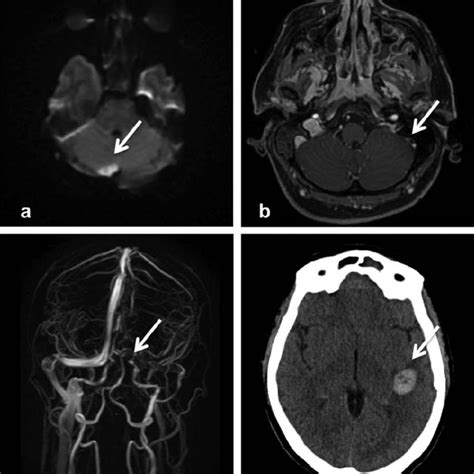 A Brain Magnetic Resonance Imaging MRI DWI Sequence Showing Acute