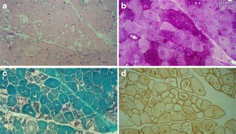 Biopsy From Right Vastus Lateralis Of A 46 Year Old Woman With Lopd