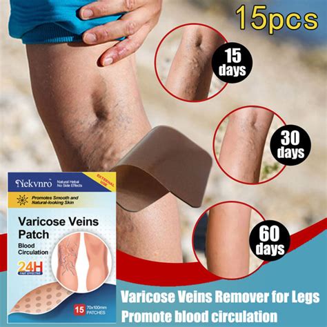 Varicose Vein Removal Plaster Herbal Repair Varicosity Angiitis