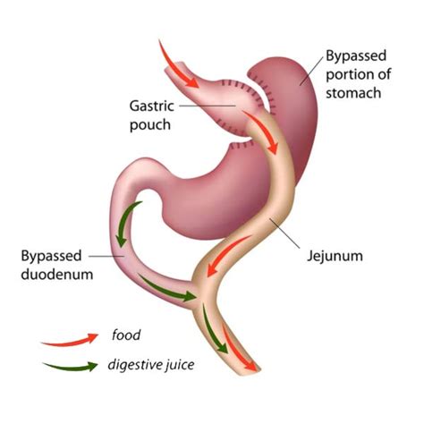 Bariatric Surgery Revision Houston Tx Revision Weight Loss Surgery Northwest Endosurgical