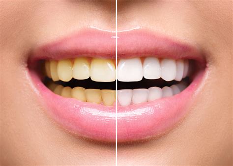 Teeth Whitening After Braces - Belmar Orthodontics