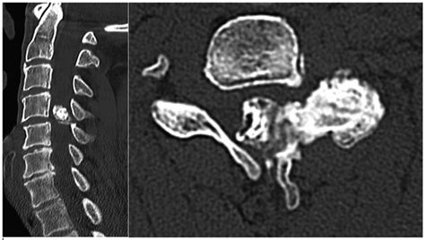 Showing Pre Operative Ct Scans Sagittal And Horizontal Views Of The Download Scientific