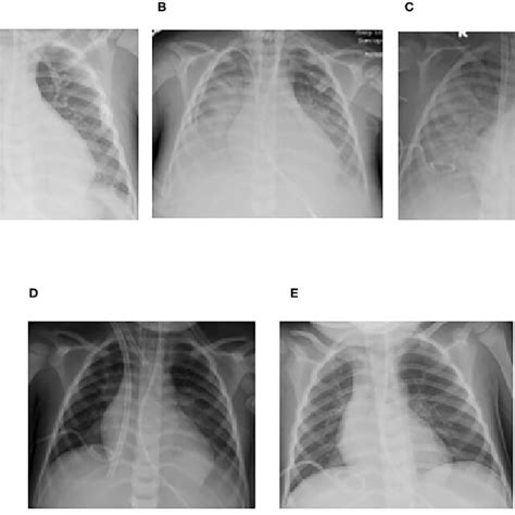 Serial Chest Radiographs For Case 2 Demonstrating The Progression And