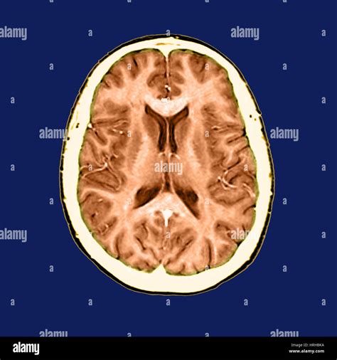 Cerebro Seccional Fotograf As E Im Genes De Alta Resoluci N Alamy