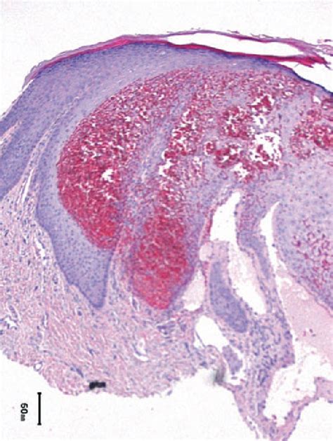 Figure 1 From A Rare Case Of Congenital Angiokeratoma Of The Glans Penis Treated Using A 595nm