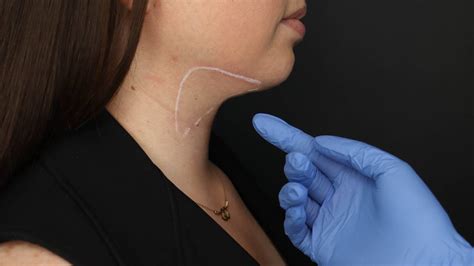 Double Chin Treatment Crystal Care Clinic