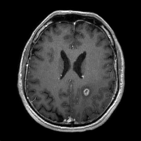 Neurosyphilis Mri