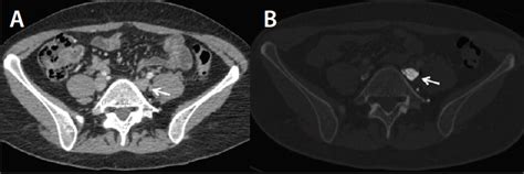 CT Venography Technique And Indications Endovascular Today