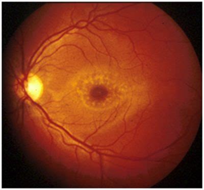 Retina Vitreo Enfermedades Hereditarias De La Retina Distrofias