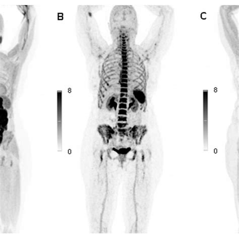 11C Methionine 68Ga Pentixafor And 18F FDG PET CT Scans In A Patient