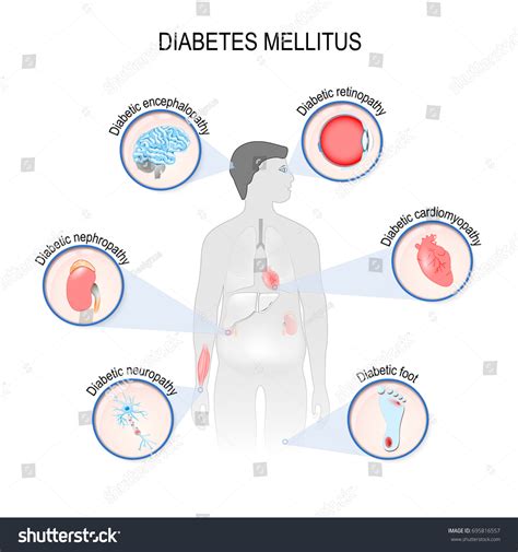 Complications Diabetes Mellitus Nephropathy Diabetic Foot Stock ...