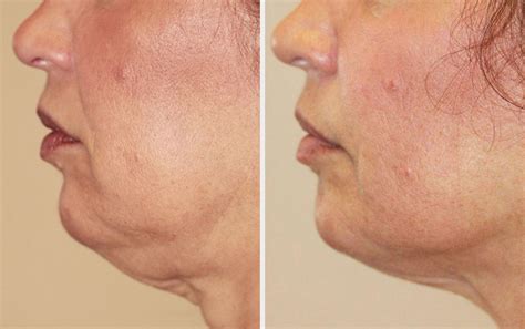 Radiofrequency Skin Tightening Renew Medical Aesthetics Cheshire