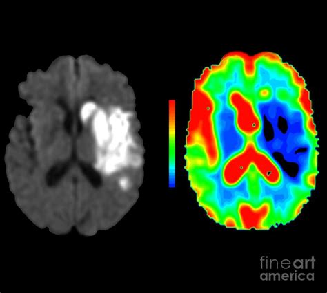 Brain Damage Due To A Stroke Photograph by Zephyr/science Photo Library ...