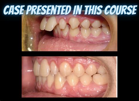 Class Ii Treatments With Clear Aligners The Clear Institute