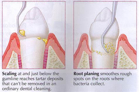 Scaling And Root Planing Dr Ahdout Dmd Irvine Periodontist