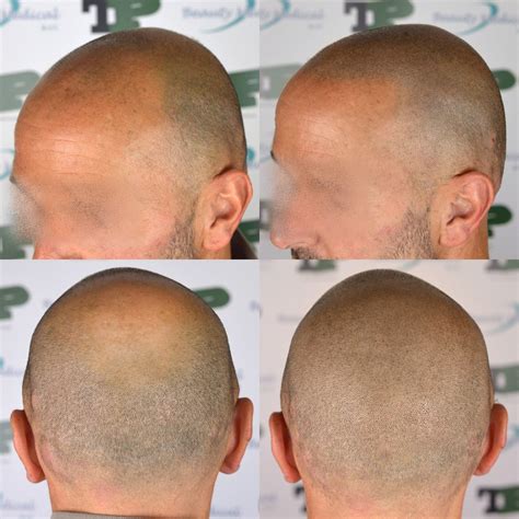 Caso Tricopigmentazione Effetto Rasato Con Hairline Conservativa