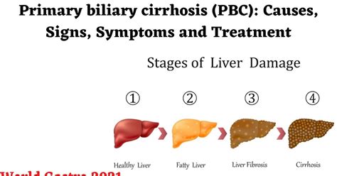 Primary biliary cirrhosis (PBC): Causes, Signs, Symptoms and Treatment