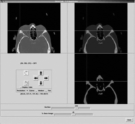 Point To Point Computer Assisted Navigation For Precise Transfer Of